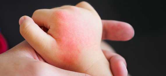 Patches of red, itchy skin, or heat rash on child's hand